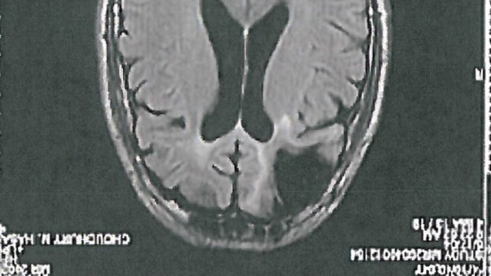 A brain scan shows the missing portion of Cecil Claytonâs brain. Clayton suffered brain damage in a sawmill accident that required one-fifth of his frontal lobe to be removed.