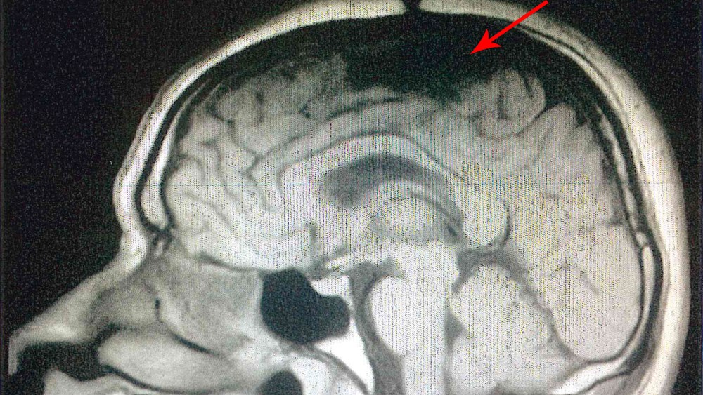 A scan of Ernest John’s brain shows a hole in his skull and brain missing, from an affidavit of Dr. Joel Zivot.