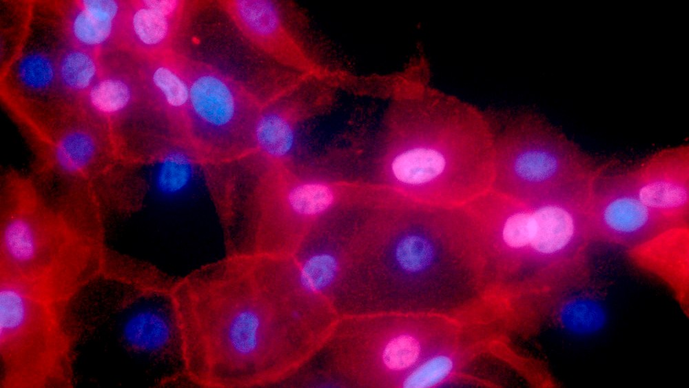 Image: A culture of human breast cancer cells