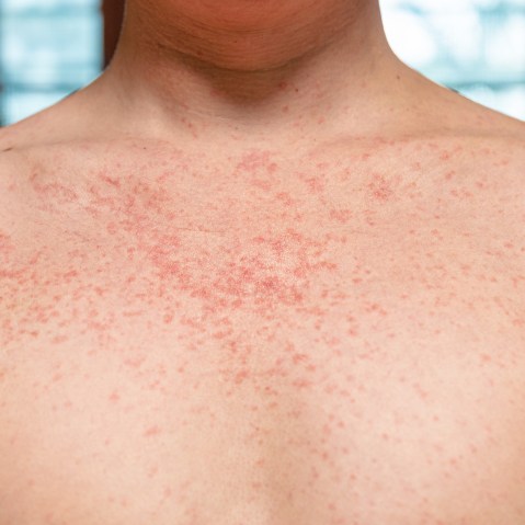 Measles on a young adult.