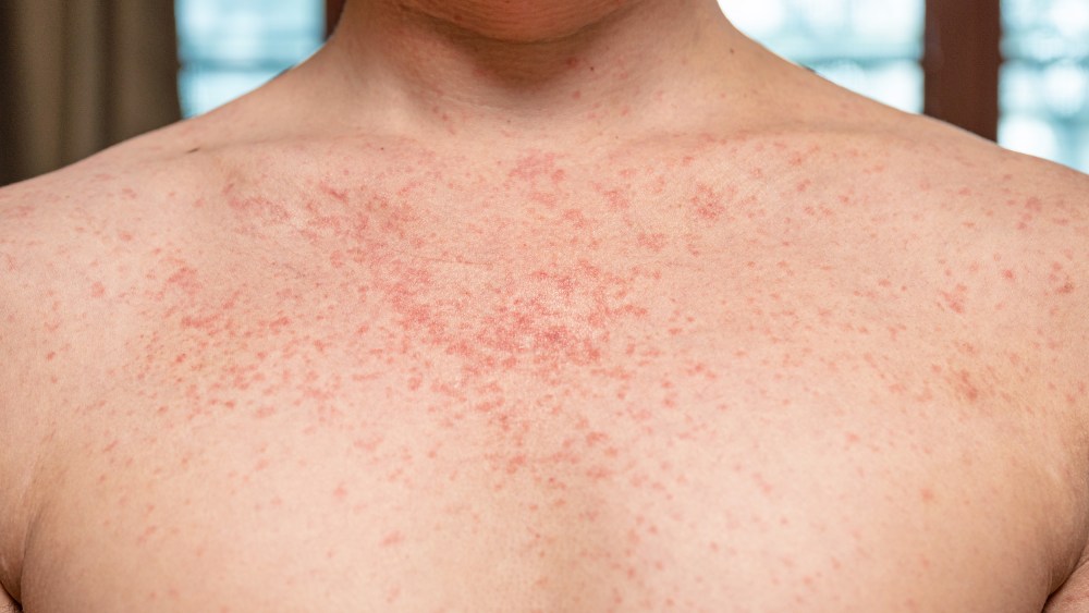 Measles on a young adult.