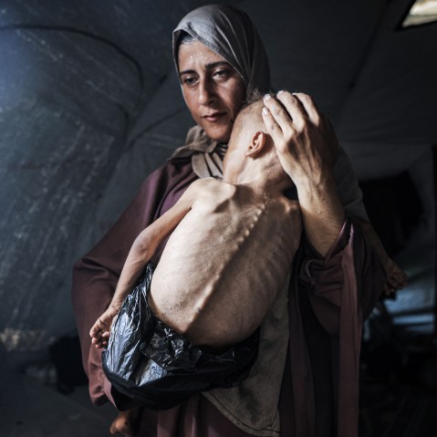 DO NOT USE - max

Muhammad Zakariya Ayyoub al-Matouq, a 1.5-year-old child in Gaza City, Gaza, faces life-threatening malnutrition as the humanitarian situation worsens due to ongoing Israeli attacks and blockade, on July 21, 2025.