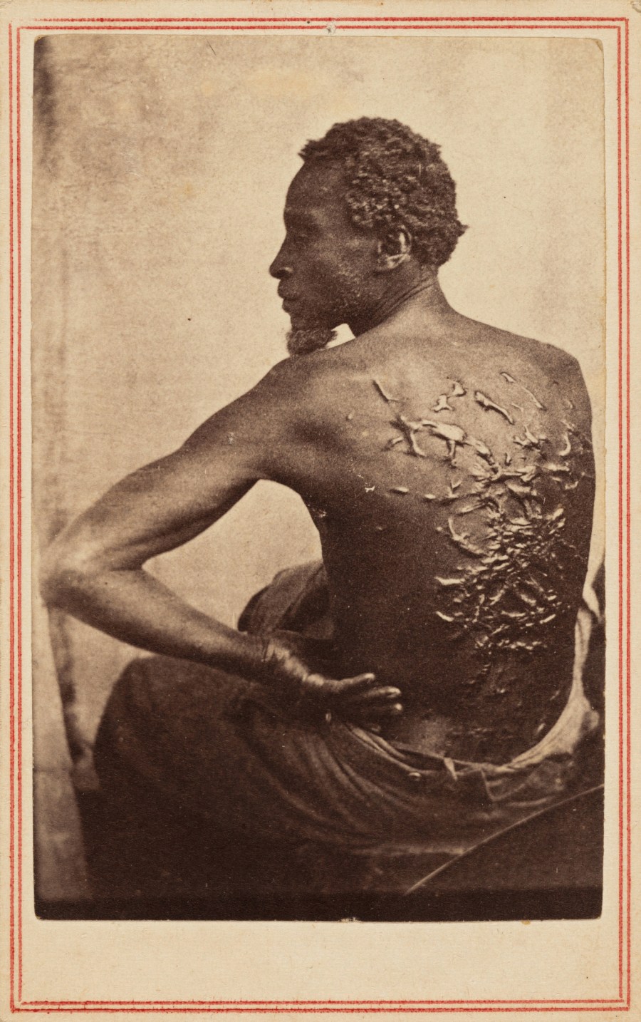 A man is seated, back to the camera, showing many raised scars on his back