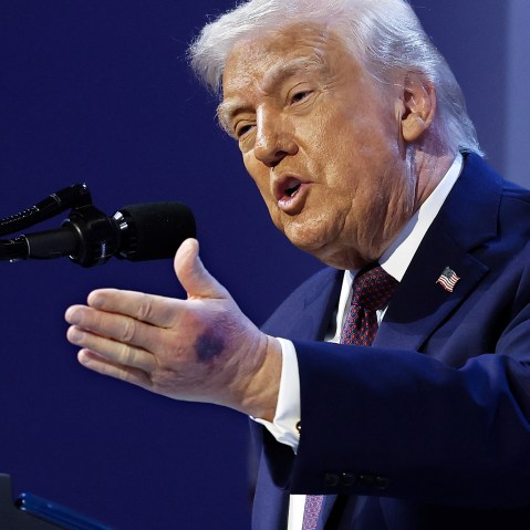 A bruise can be seen on the back of President Donald Trump's left hand during a signing ceremony for the “Board of Peace” on Jan. 22, 2026 in Davos, Switzerland.