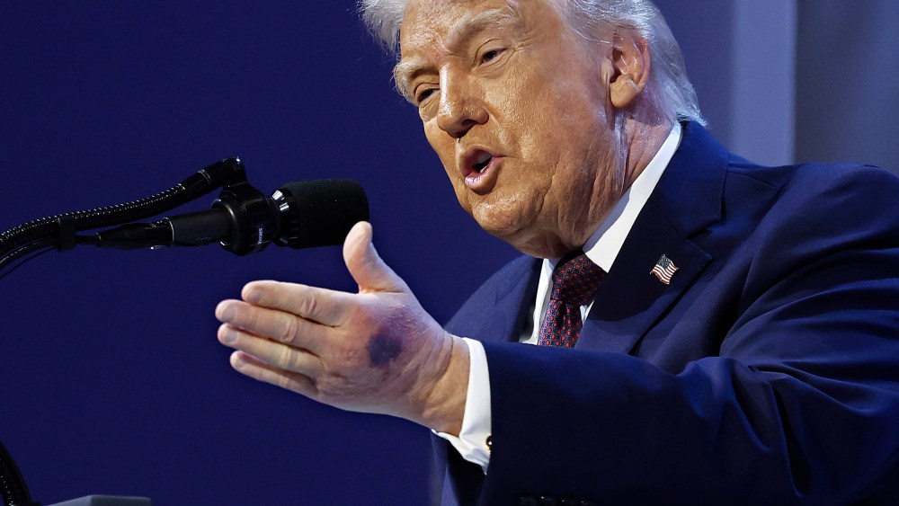 A bruise can be seen on the back of President Donald Trump's left hand during a signing ceremony for the “Board of Peace” on Jan. 22, 2026 in Davos, Switzerland.