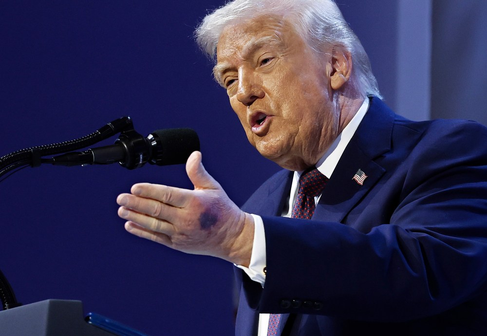 A bruise can be seen on the back of President Donald Trump's left hand during a signing ceremony for the “Board of Peace” on Jan. 22, 2026 in Davos, Switzerland.